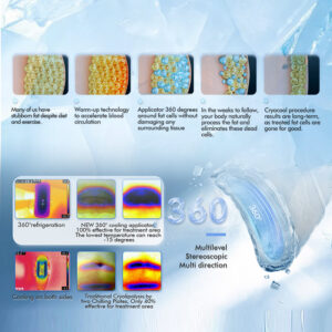  Cryolipolysis Cryocool