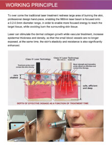 Removal Laser for Spider Vein Blood Vessels Removal