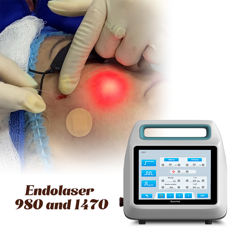 endolift