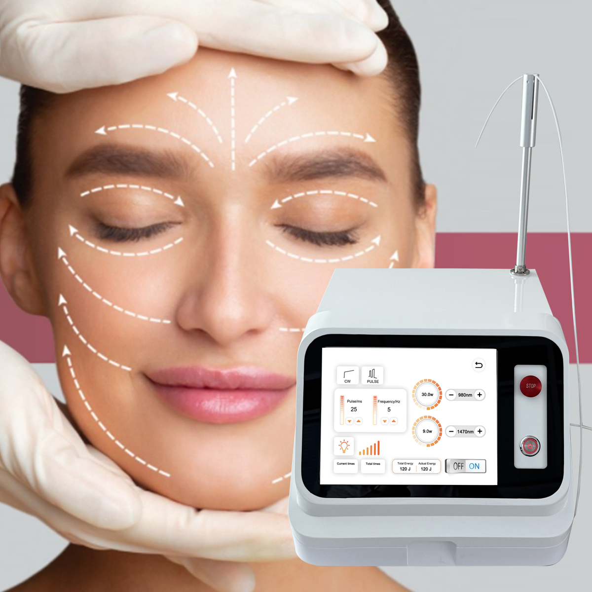 endolift